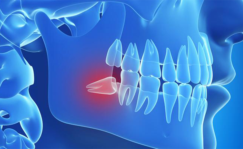 Denti-inclusi-inclusione-dentaria Canini inclusi: diagnosi, terapia e complicanze