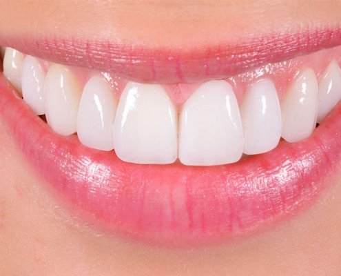 Odontoiatria estetica le faccette dentali