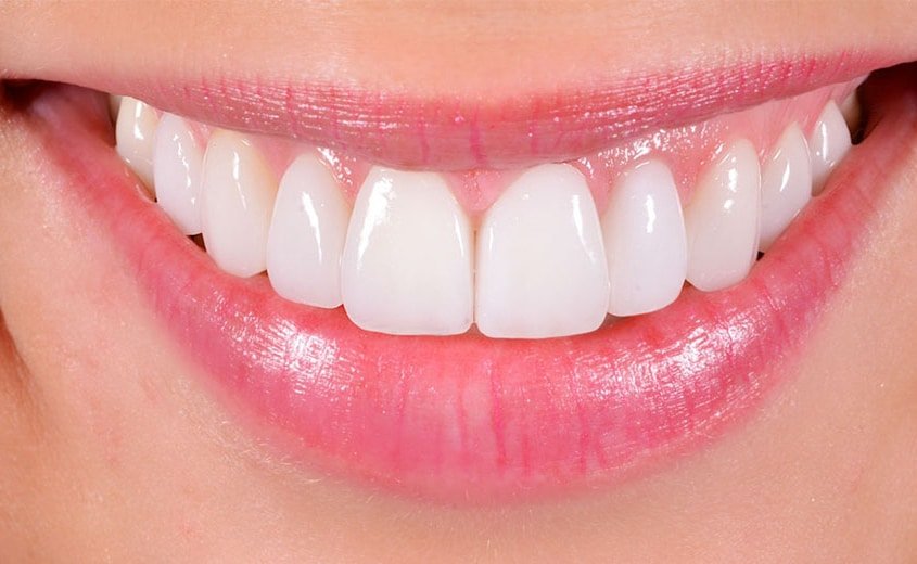 Odontoiatria estetica le faccette dentali