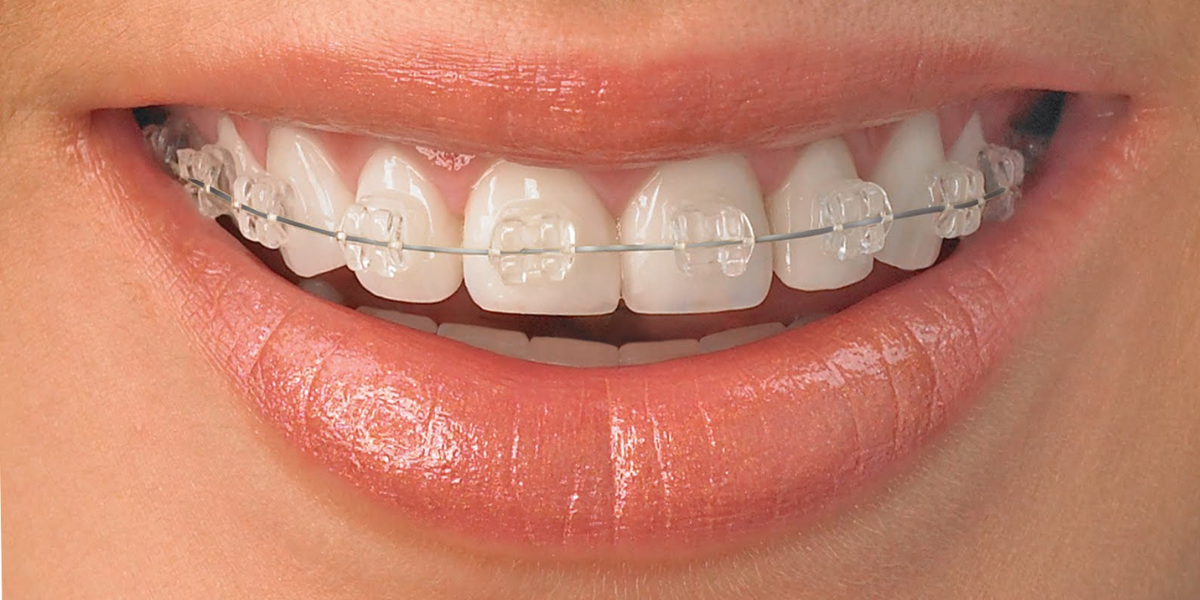 Ortodonzia fissa estetica