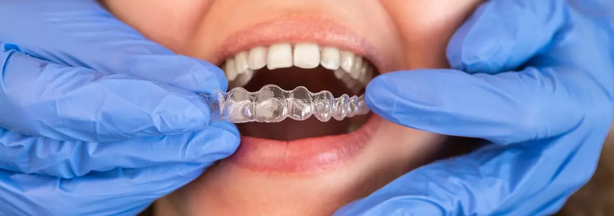 Denti allineati con l’ortodonzia invisibile Invisalign
