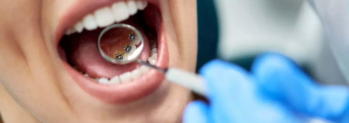 Correggere le malocclusioni con ortodonzia linguale