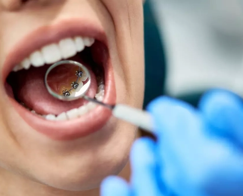 Correggere le malocclusioni con ortodonzia linguale