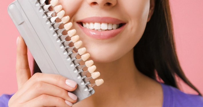 Faccette dentali, come possono migliorare l’estetica del sorriso?