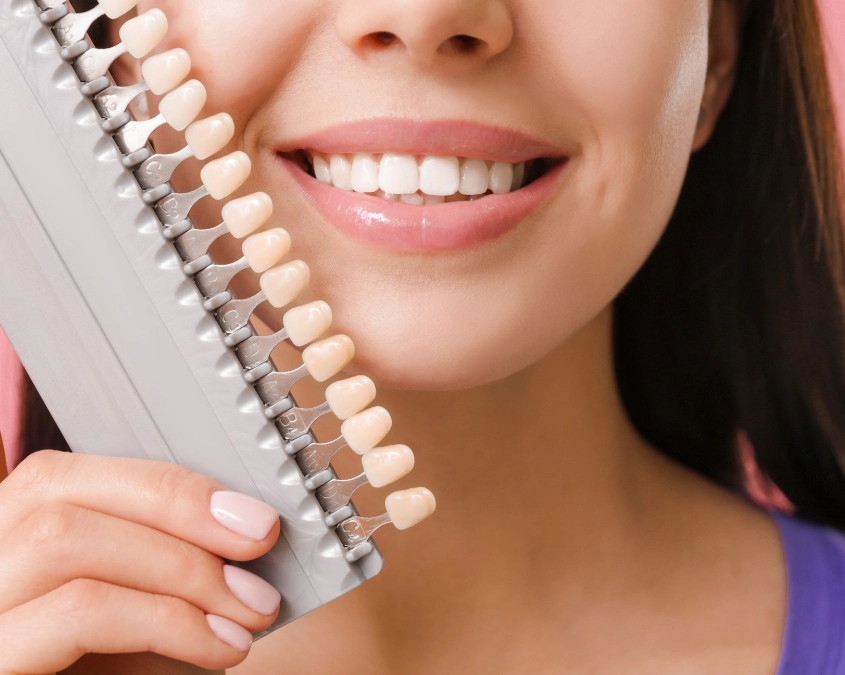 Faccette dentali, come possono migliorare l’estetica del sorriso?