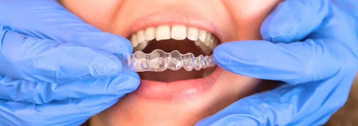 Tutte le fasi del trattamento con Invisalign: dalla diagnosi al sorriso perfetto