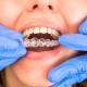 Tutte le fasi del trattamento con Invisalign: dalla diagnosi al sorriso perfetto