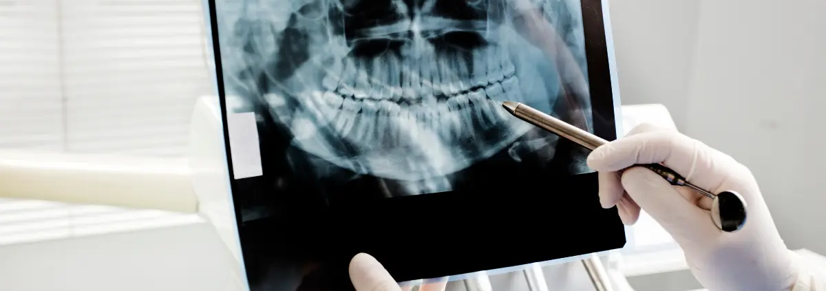 Agenesie dentali e ripercussioni ortodontiche