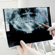 Agenesie dentali e ripercussioni ortodontiche