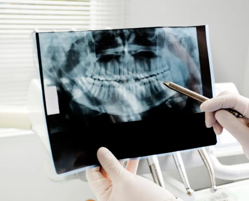 Agenesie dentali e ripercussioni ortodontiche