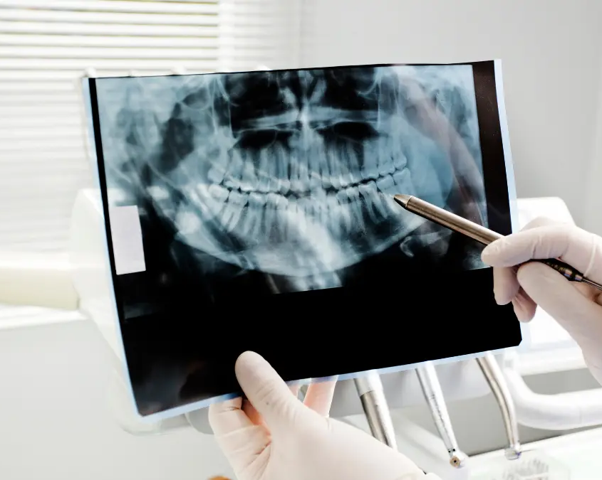 Agenesie dentali e ripercussioni ortodontiche